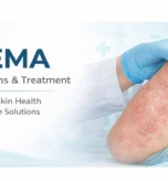 ECZEMA Causes, Symptoms & Treatment