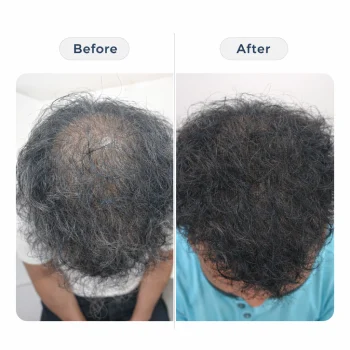 GFC Therapy with Microneedling