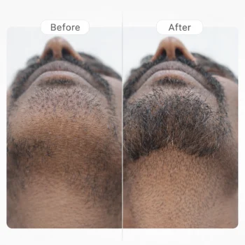 ILS Therapy for Alopecia Areata