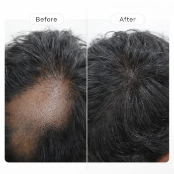 ILS Therapy for Alopecia Areata