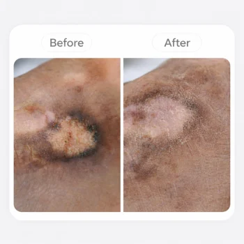 Intralesional Steroid Therapy